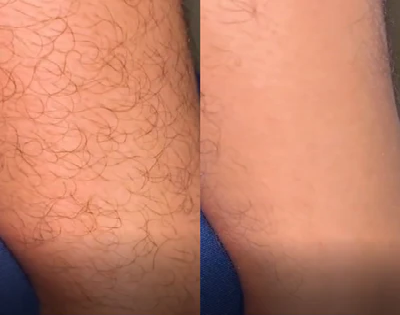 Smooth Body Hair Eraser